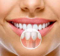 Diş implant tedavisi